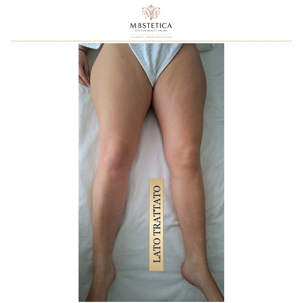 Rimodellamento gambe lato trattato Genova prima e dopo