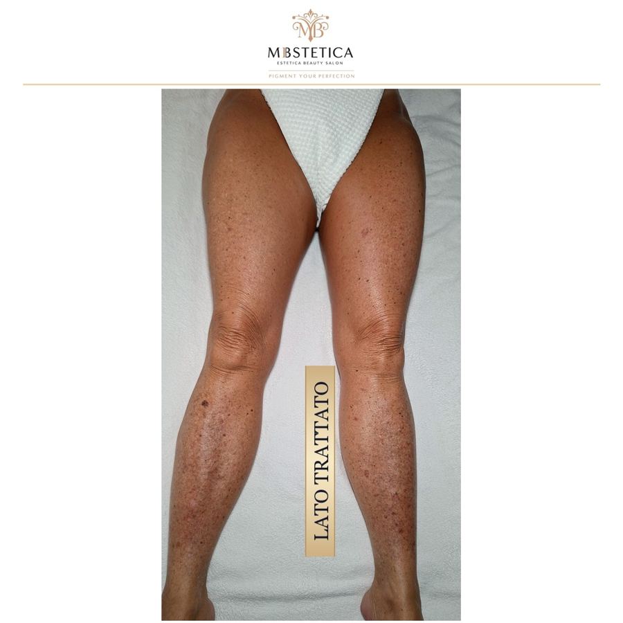 Rimodellamento gambe Genova lato trattato