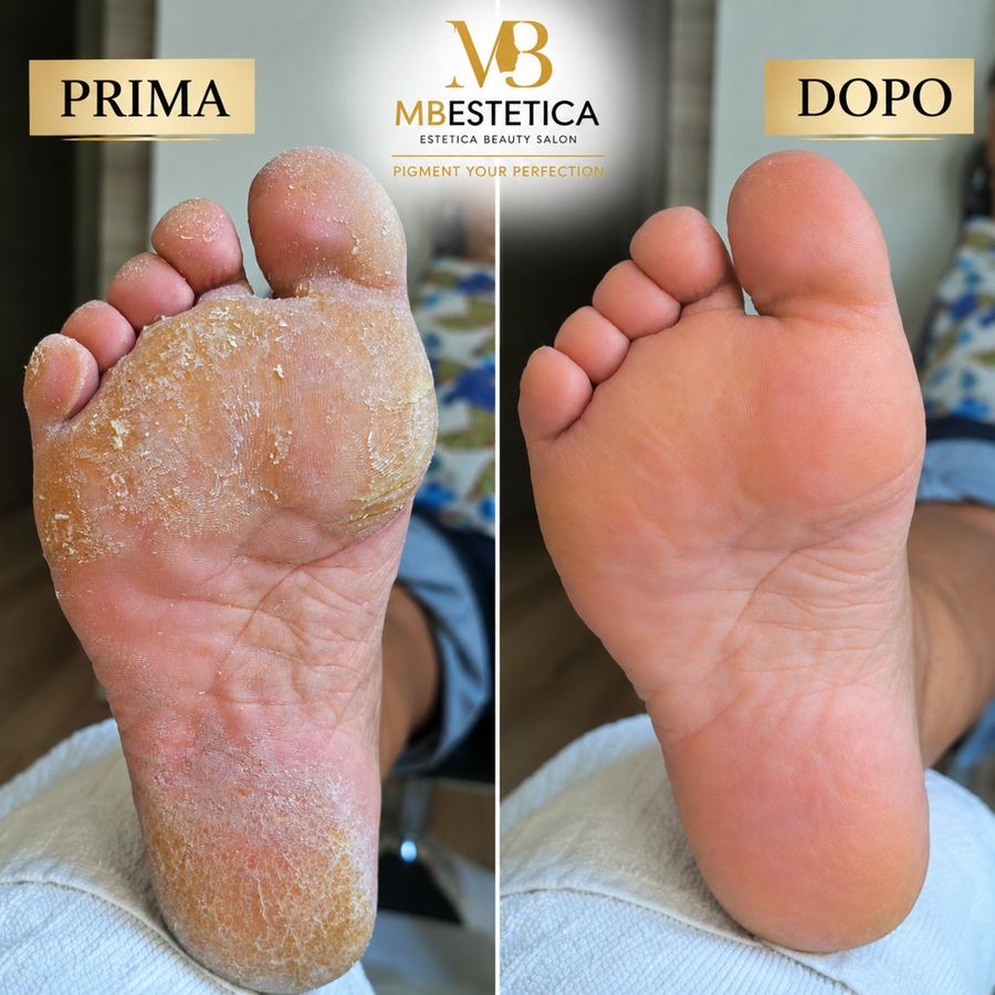 Pedicure profondo Genova prima e dopo