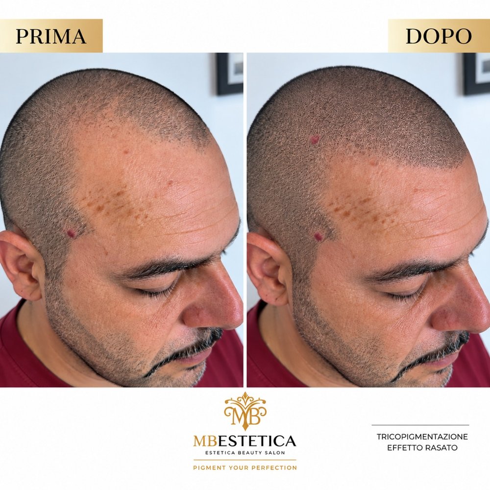 Tricopigmentazione effetto rasato stempiatura Genova prima e dopo