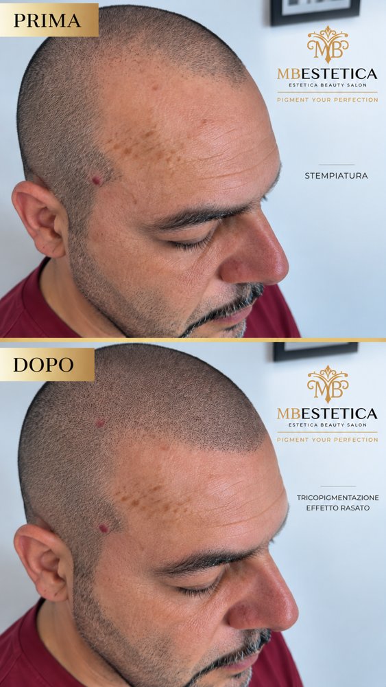 Tricopigmentazione effetto rasato uomo calvizie Genova prima e dopo