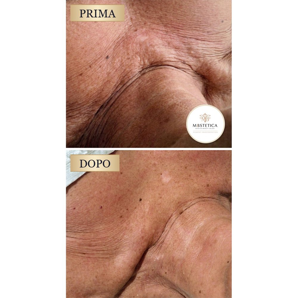 Biostimolazione collo e décolleté Genova prima e dopo