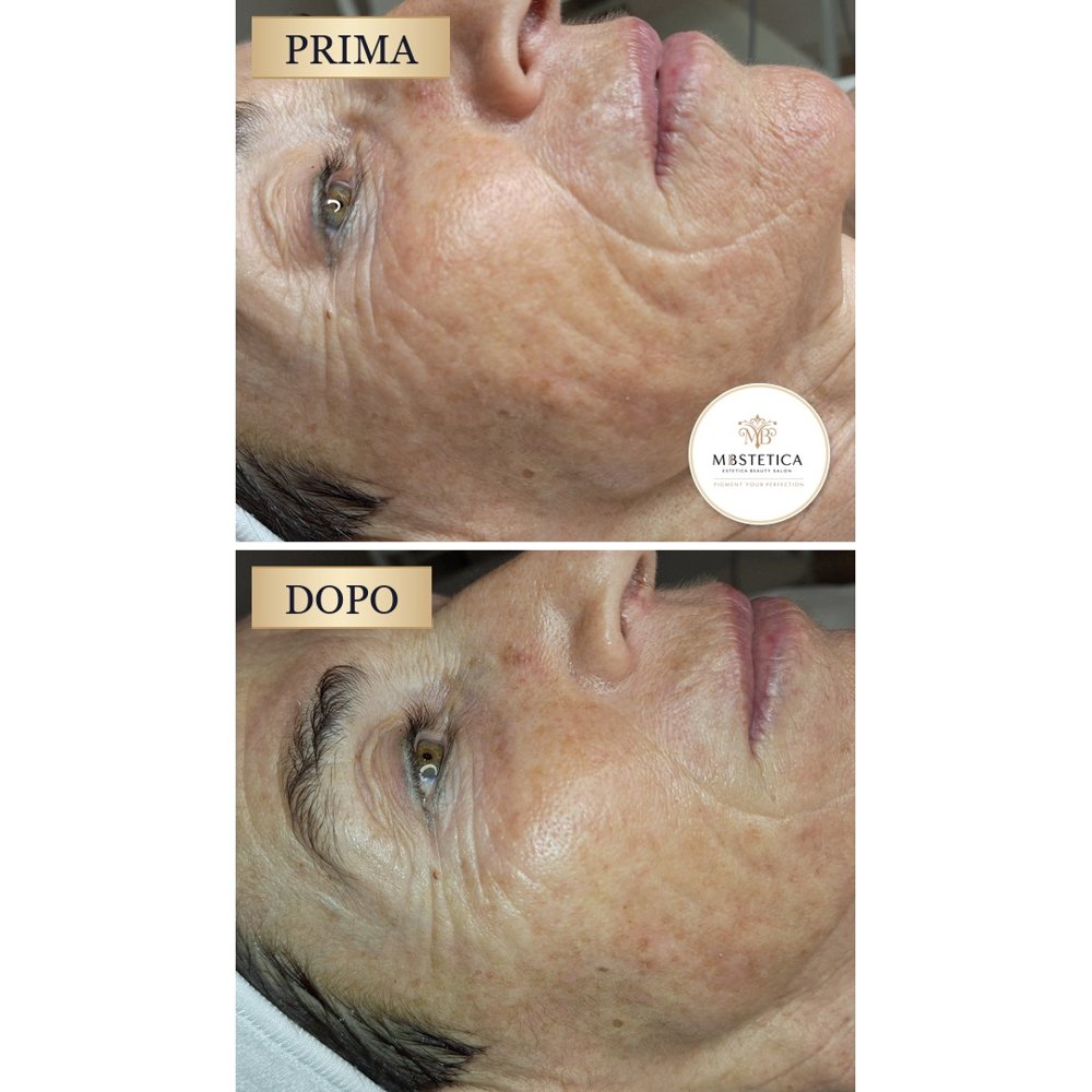 Lifting viso veicolazione transdermica Genova prima e dopo