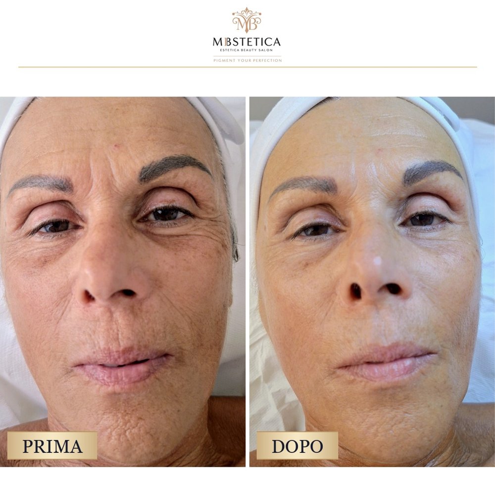 Nano-needling viso Genova prima e dopo