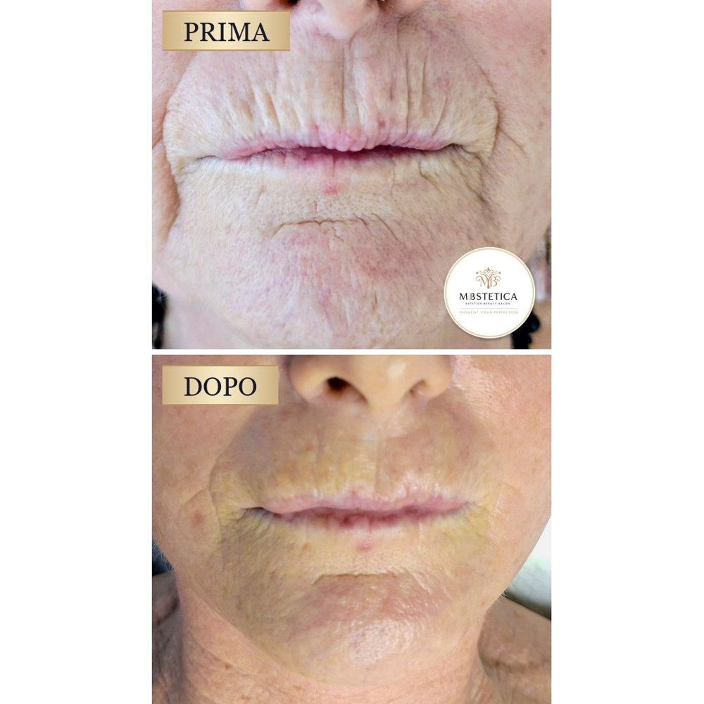 Biostimolazione rughe intorno alla bocca Genova prima e dopo