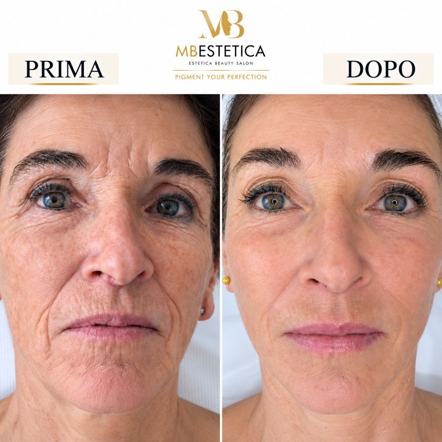 Biostimolazione viso needling cosmetico Genova prima e dopo
